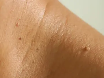 From Diagnosis To Treatment: How Pictures Of Skin Tags Can Help You Take Control Of Your Health