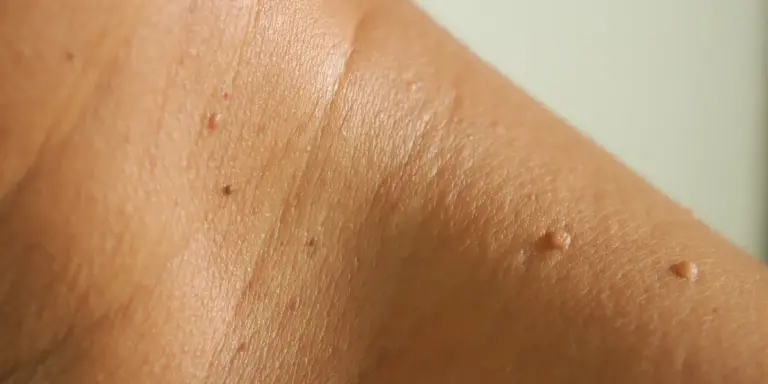 From Diagnosis To Treatment: How Pictures Of Skin Tags Can Help You Take Control Of Your Health