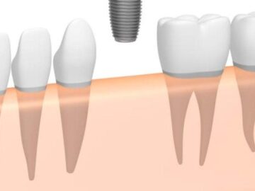 A Comprehensive Guide to Navigating the World of Dental Implants