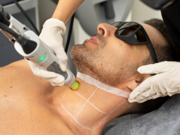 Laser Hair Removal Treatments In Toronto And The GTA | A Comprehensive Guide