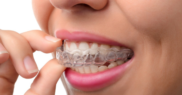 Top 10 Benefits of Invisalign Over Conventional Braces 