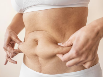 Cavitation Machine: Targeted Fat Reduction for Specific Body Areas