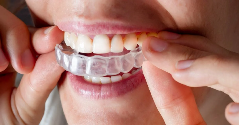 The True Cost of Invisalign: What You Need to Know