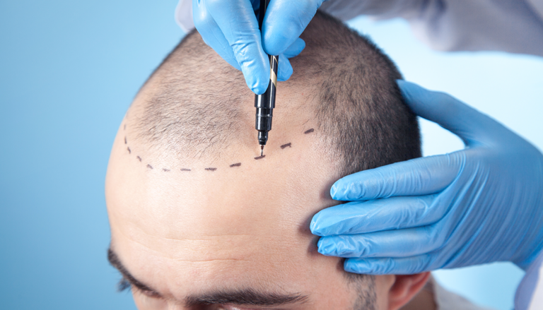Checklist Before Hair Transplant Surgery In Malaysia