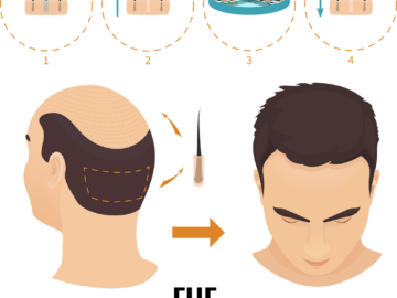 FUE Hair Transplant: Your Path to Renewed Confidence with a Free Consultation in London