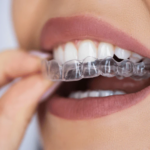 Why You Should Use Clear Aligners