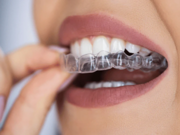 Why You Should Use Clear Aligners