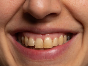 What Causes Yellow Discoloration in Teeth?