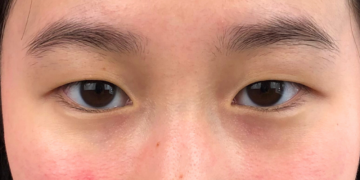 Revealing the Eyes' Beauty: Double Eyelid Surgery vs Thread Lifts in Sydney